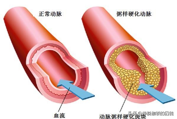 老人预防脑梗锻炼方法,老人预防脑梗每日吃多少叶酸片
