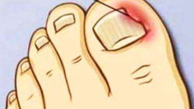 甲沟炎怎么初期治疗才能彻底根除,甲沟炎患者有多痛苦