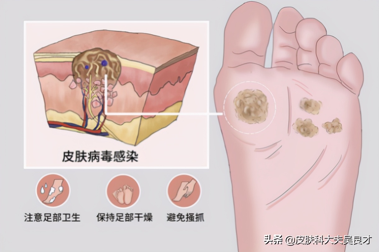 初期鸡眼和跖疣的区别,鸡眼和跖疣最简单的区别