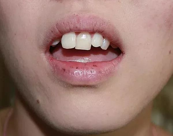 黑斑息肉综合征有什么症状,黑斑息肉综合征临床表现