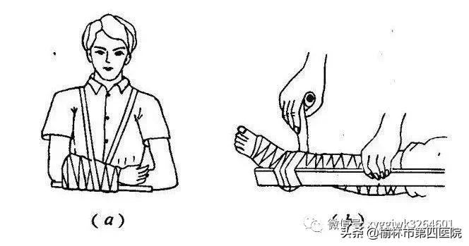 石膏固定术健康宣教小视频,骨折复位后石膏外固定多久