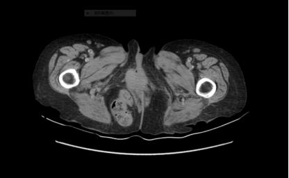 腹股沟疝有几种类型如何鉴别,腹股沟疝有哪些特点