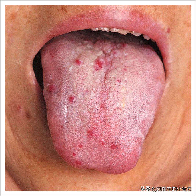 舌象图解大全中医舌诊,最全中医舌诊图谱来了