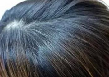 16岁青少年长白发原因,高中生狂长白发怎么回事