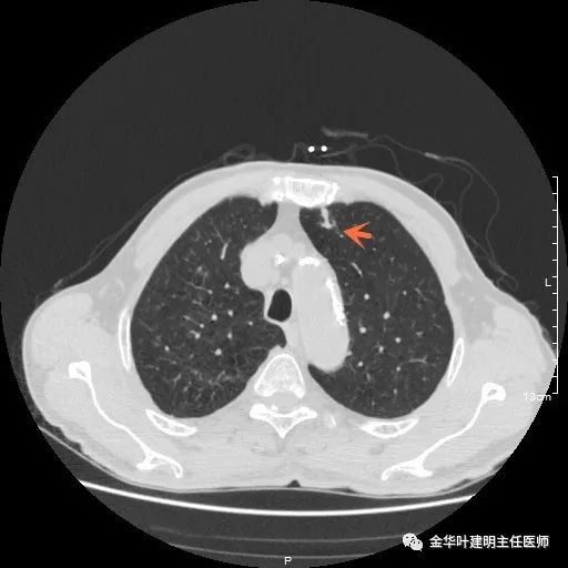 多发原发肺癌能根治吗,肺部原发性恶性肿瘤好治