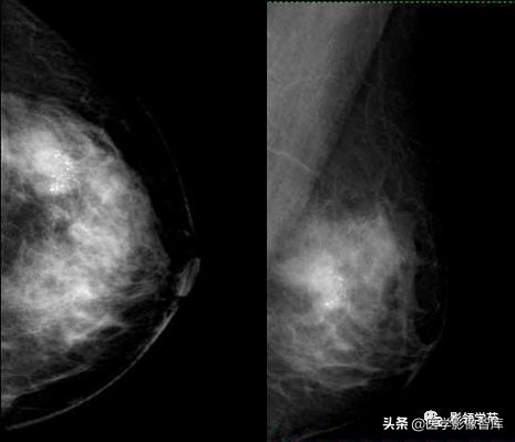 乳腺钙化怎么区分良性和恶性,乳腺钙化的诊断与分级
