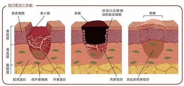 肛肠外科手术伤口护理,肛肠手术伤口换药用什么药好