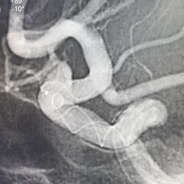 Tubridge®治疗多发性动脉瘤