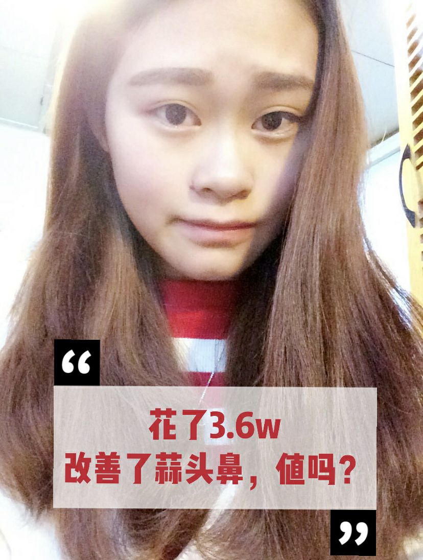 蒜头鼻怎么自己改善真实有效,花了3w整的鼻子是不是失败了