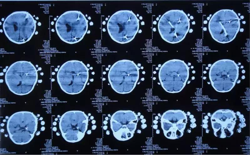 孩子脑积水反复发烧,婴儿脑积水引起发烧如何保守治疗