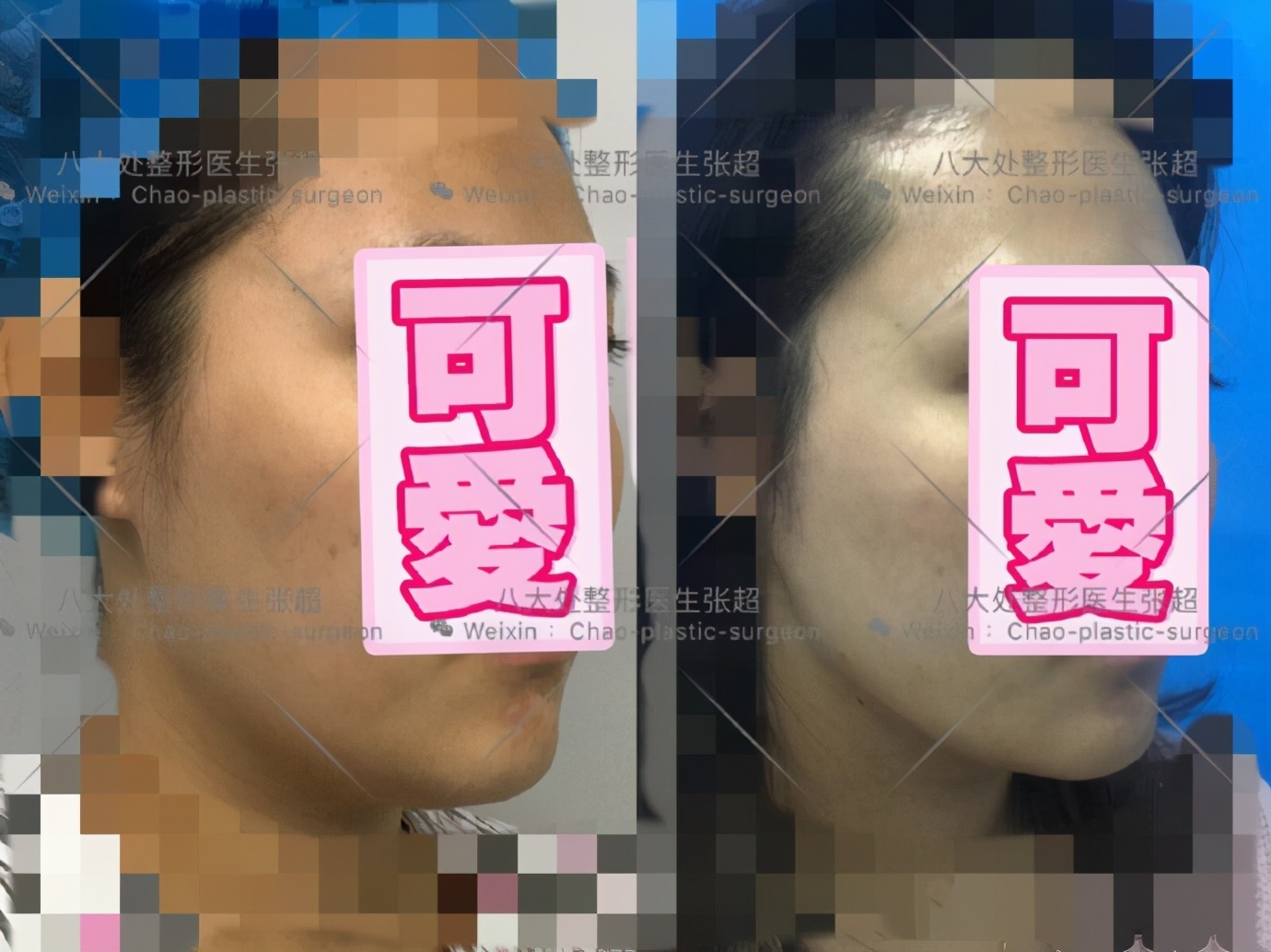 八大处整形张超,八大处张超最新视频