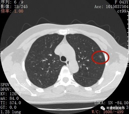 怎样从病理报告看是不是原位癌,原位腺癌切除子宫要开刀吗