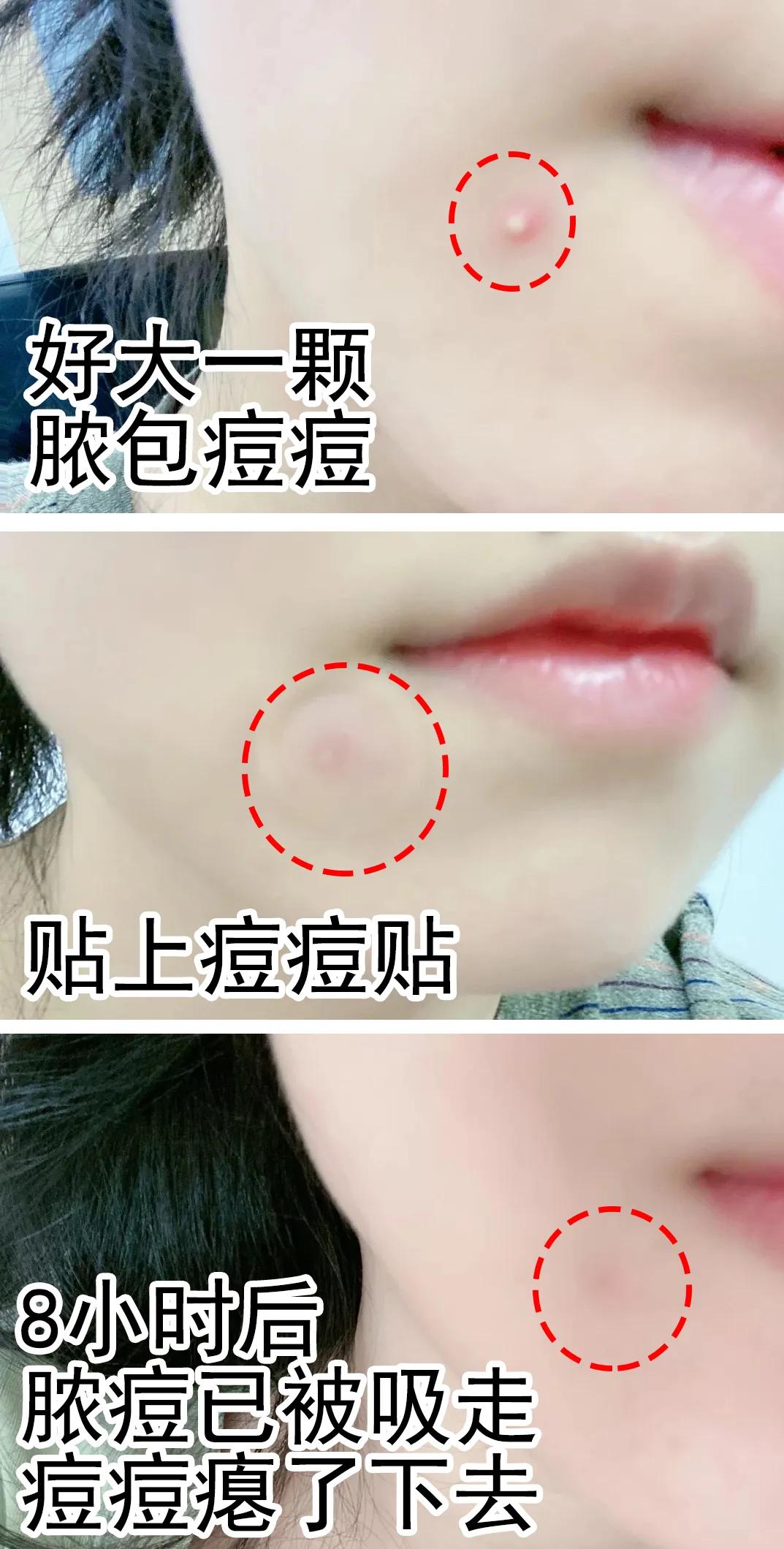 片仔癀痘痘贴解救痘痘,片仔癀祛痘印最有效的方法