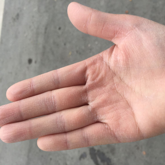 手凉手心老是出汗怎么解决,手心出汗怎判断是热汗还是凉汗
