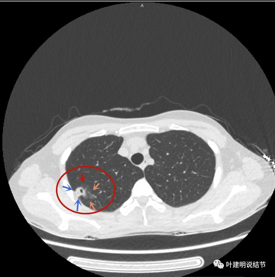 临床诊断孤立性肺结节,空洞型结节一般是什么性质