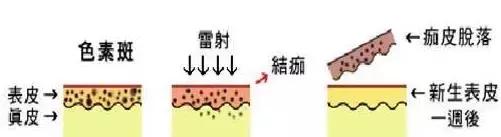 激光祛斑后的护理怎么做,皮秒激光祛斑术后护理
