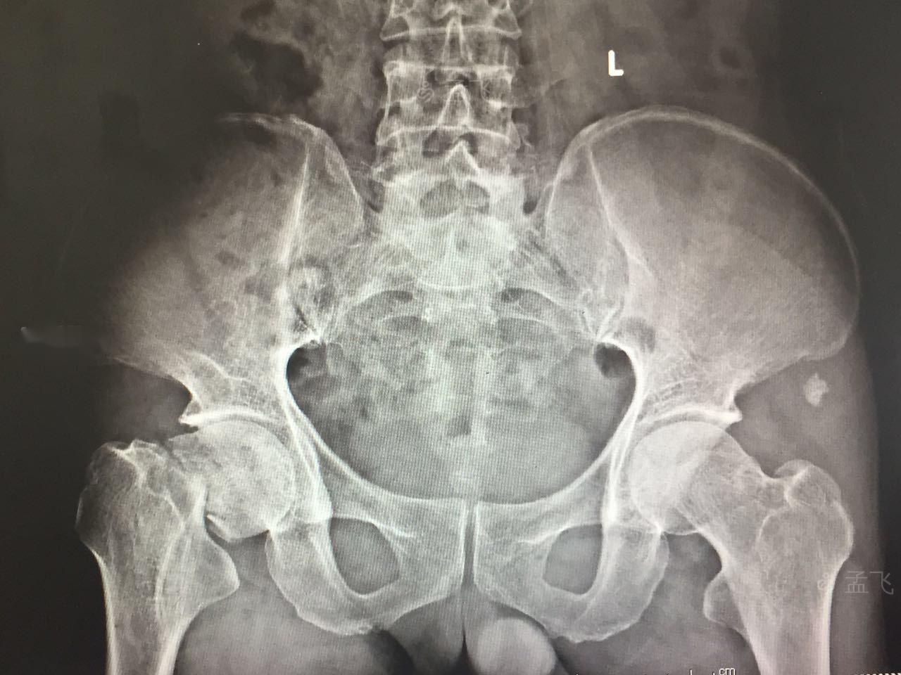 左股骨颈骨折被称为最后一次骨折,髋关节骨折和股骨颈骨折区别在哪