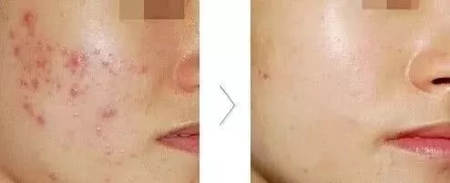 祛痘激光手术能彻底把痘痘去除吗,脸上痘痘太多做什么医美不伤皮肤