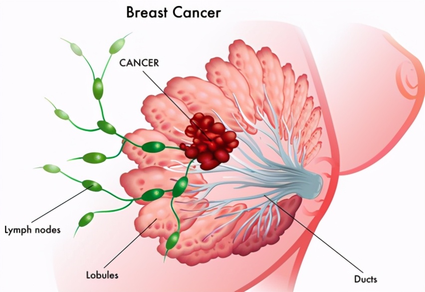 乳腺结节不重视乳腺癌的后果,乳腺结节不切除会怎样