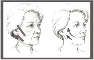 面部针灸除皱风险,眼部除皱手术风险大吗