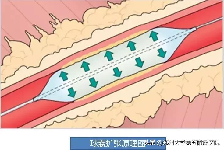 科普关于动静脉瘘手术,动静脉瘘是怎么治疗最好
