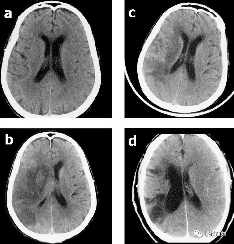 脑梗死丨演变、血供区域分布、CT表现