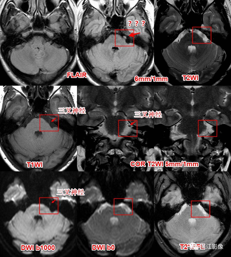 头颅mri扫描影像哪里找,头颅影像mra详细解说