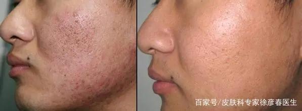 疱疹后遗症怎么治,疮疤留下的黑印怎么消除