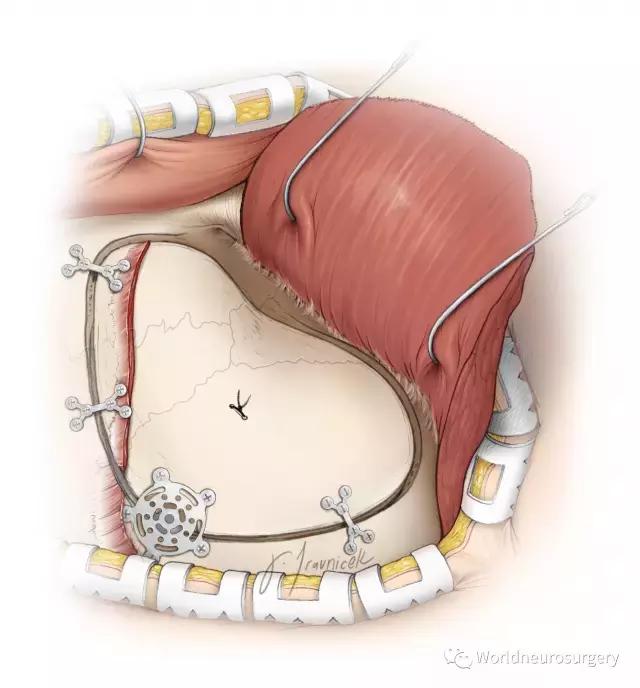 翼点入路的开颅要点,翼点开颅详解图
