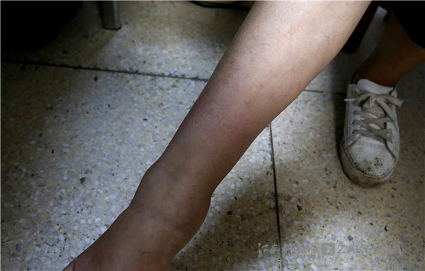 雨天皮肤病,雨季皮肤病