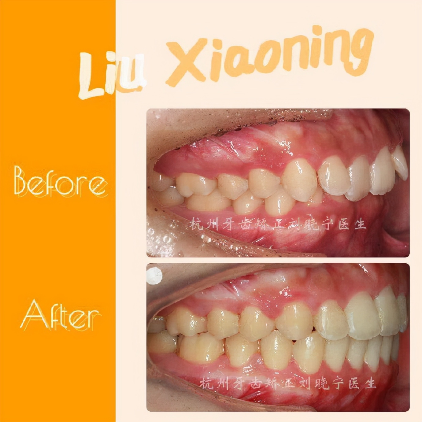 杭州舌侧牙齿矫正,舌侧矫正杭州价格