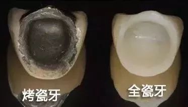 氧化锆全瓷牙的缺点和优点,牙医建议烤瓷不建议全瓷
