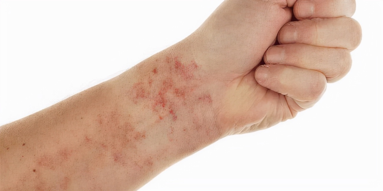 胸口周围发黑怎么办,胸口发黑起皮怎么回事