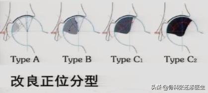 老年人股骨颈骨折会股骨头坏死吗,老年人股骨头摔断能治愈吗