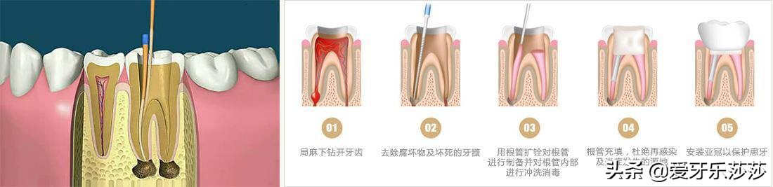 牙髓炎导致的牙齿神经疼，拔牙？根管治疗？究竟需要怎样治疗？