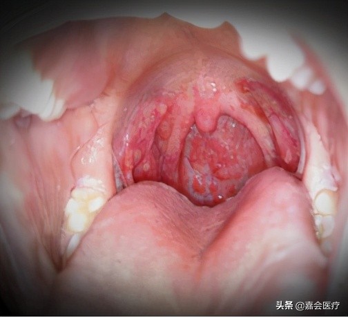 手足口病诊疗指南及解读,手足口病知识普及