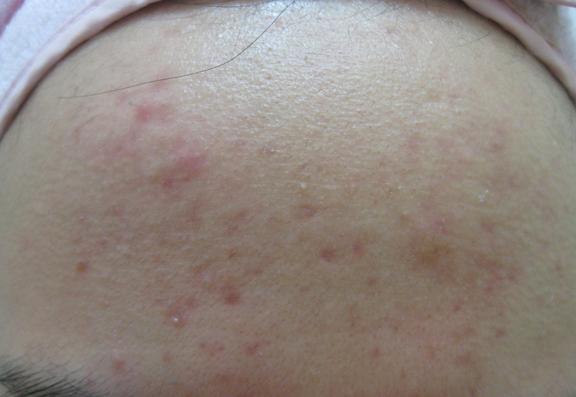 夏天痘印淡化得快吗,夏天到了痘印淡了