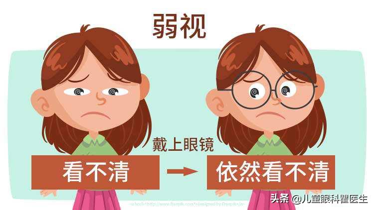 弱视恢复最佳年龄段,弱视康复黄金期内几个月能康复