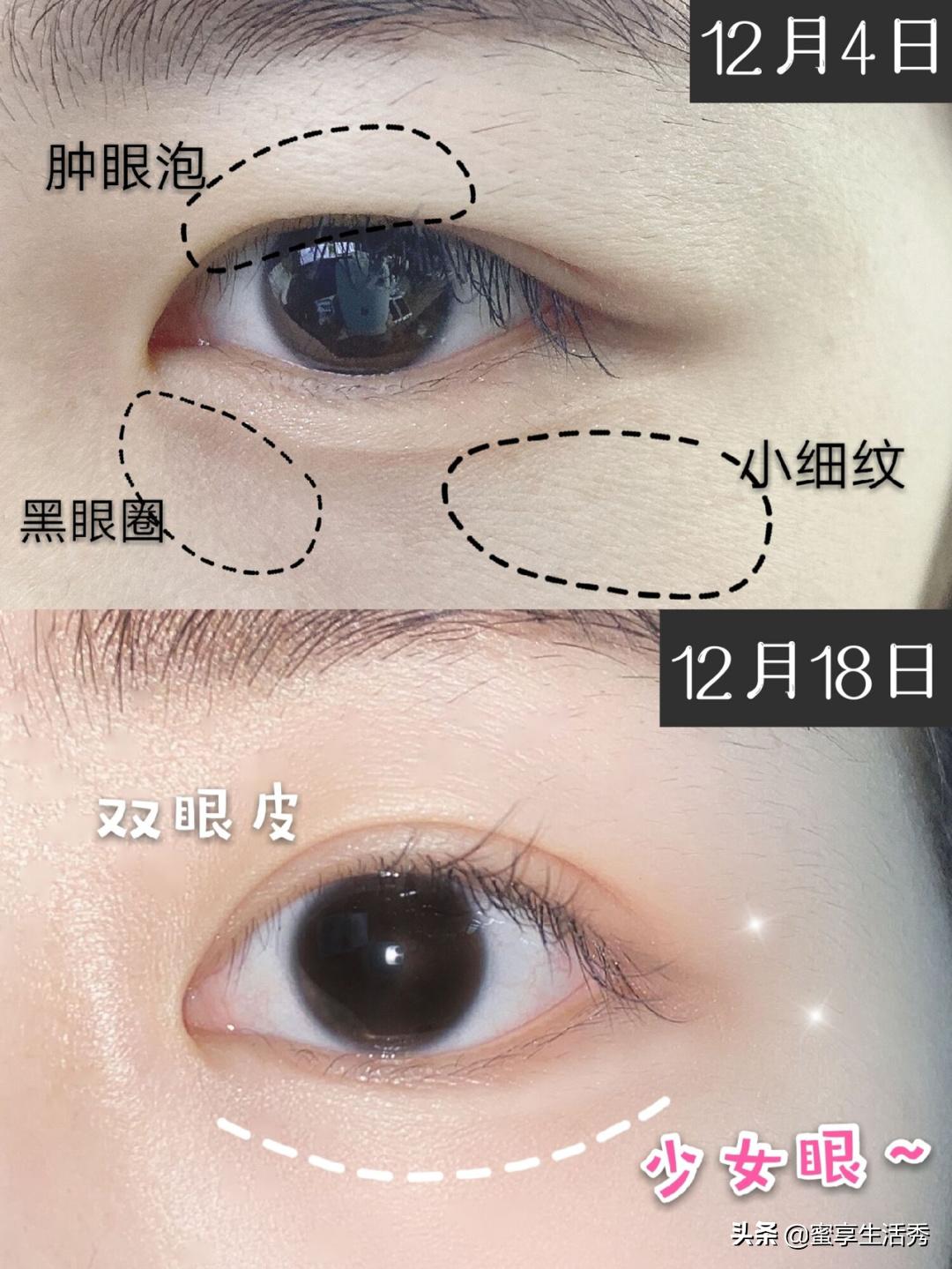 内双眼皮手术变外双效果,内双眼皮怎么变外双按摩最有效