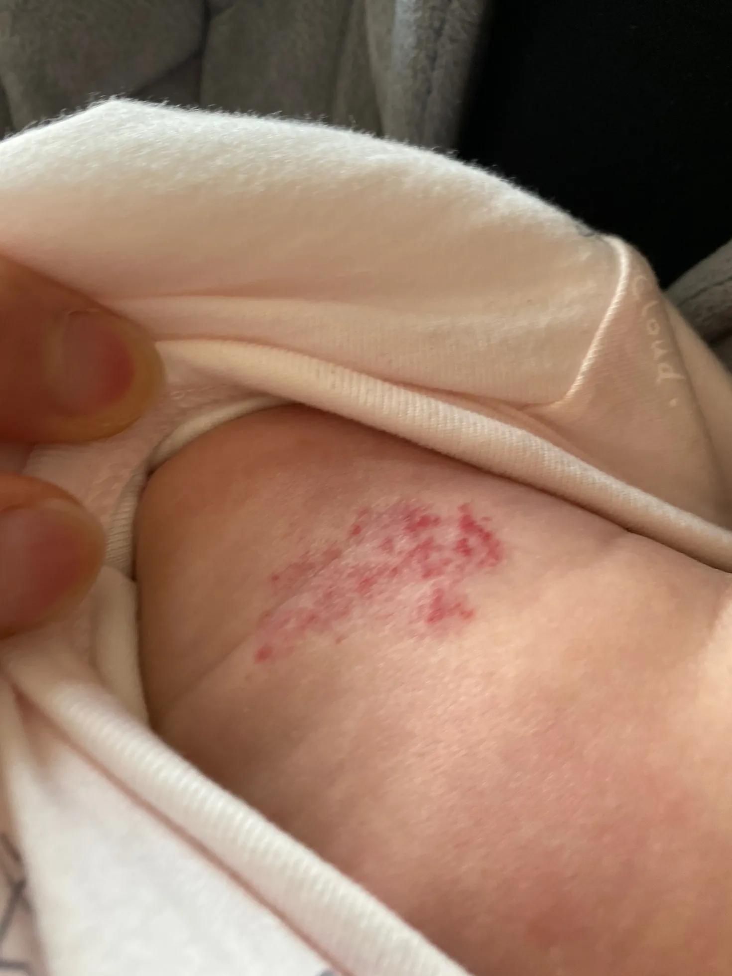 宝宝血管瘤用眼药水以后1个月淡化好多（带图）