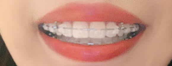 牙套日记一年级,牙套日记在线观看