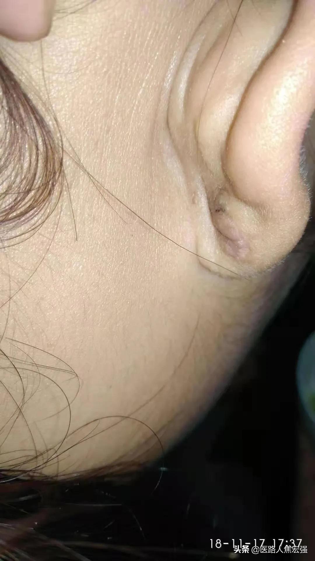 放疗对瘢痕的治疗作用,瘢痕放疗用的是什么射线