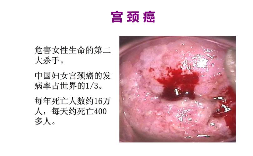 71岁女性筛查hpv高危是不是宫颈癌,男性hpv和哪些癌症有关