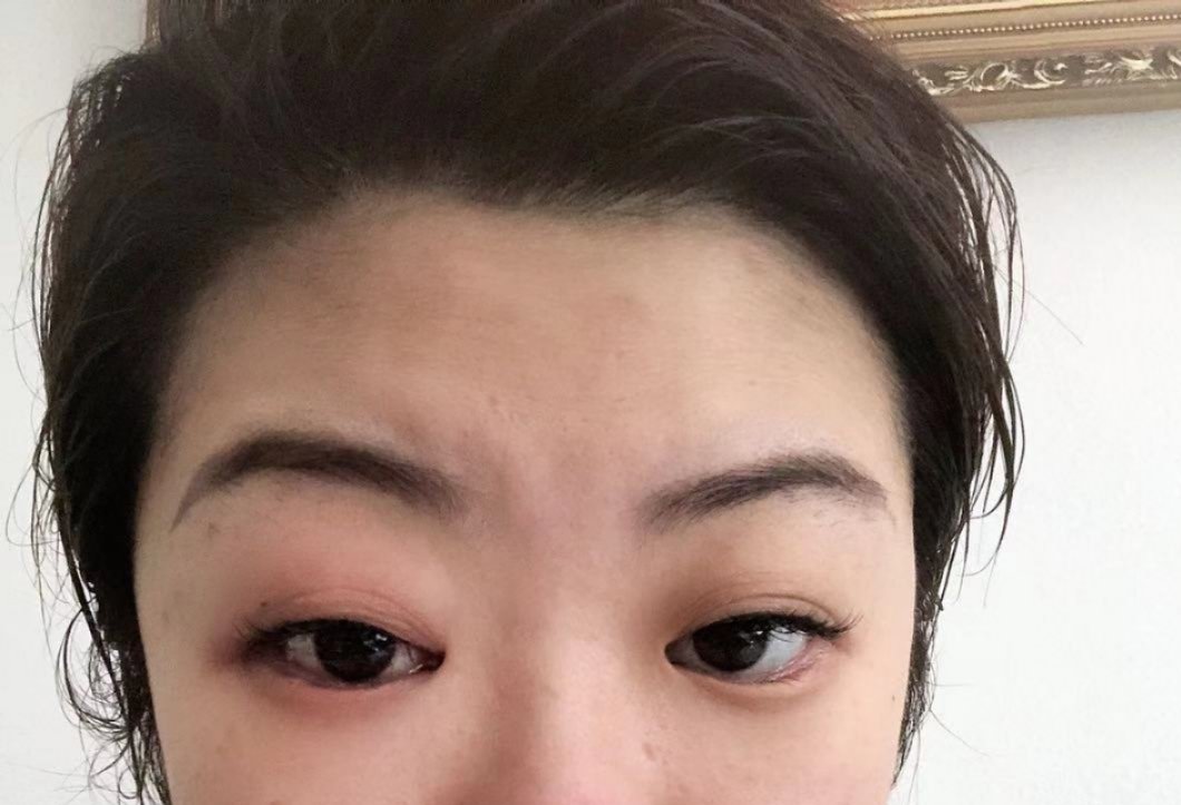 中医治疗眼部皮肤过敏,眼部红肿痒中医治疗