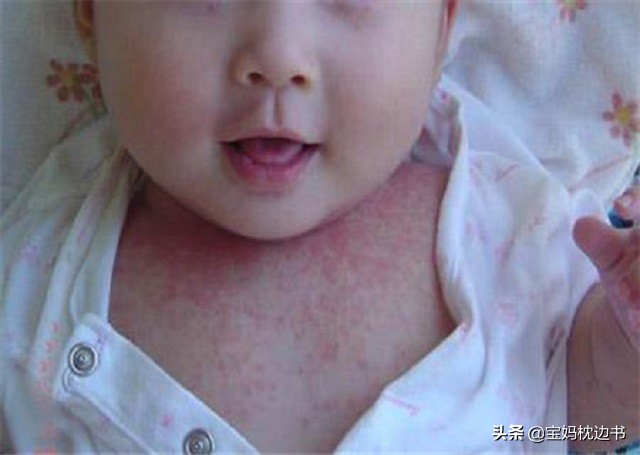 为什么我家宝宝湿疹越来越严重了,宝宝湿疹误区