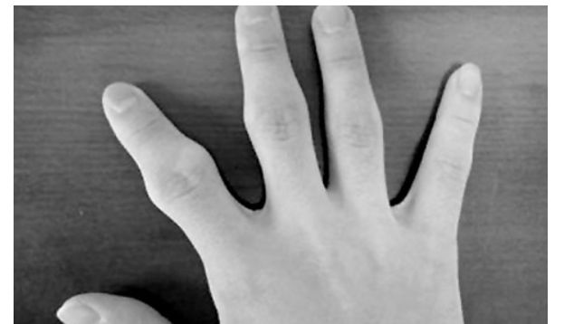 手指关节疼痛的原因和治疗方法,手指关节疼痛是什么原因30岁