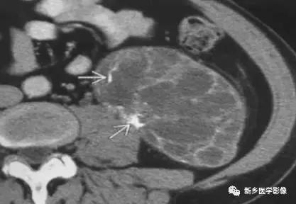 腹部平片可以看出肠胃疾病吗,腹部散在结节状高密度影