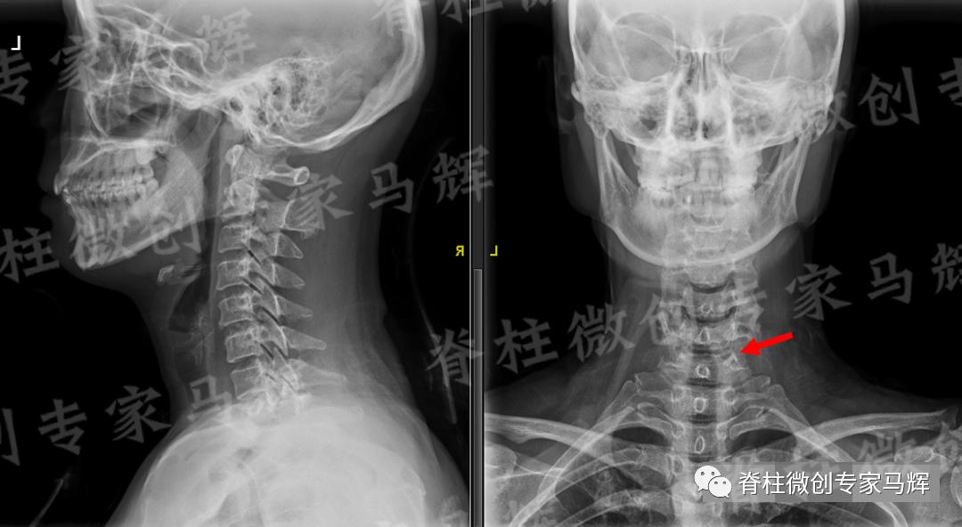 脊椎压迫神经做了微创术后腿麻疼,神经根损伤疼痛治疗