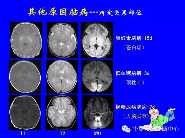新生儿颅脑mri,新生儿颅脑mr报告模板