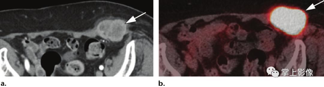 腹壁病变诊断思路,腹部影像诊断读片入门视频